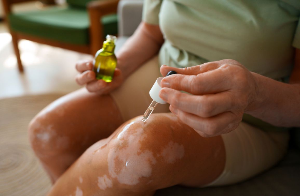 Homeopathy for Vitiligo: Natural Ways to Restore Skin