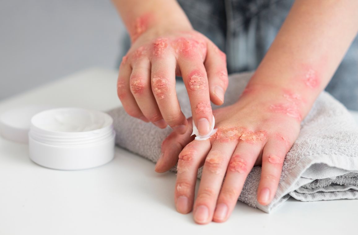 Eczema Relief Using Gentle Homeopathic Remedies